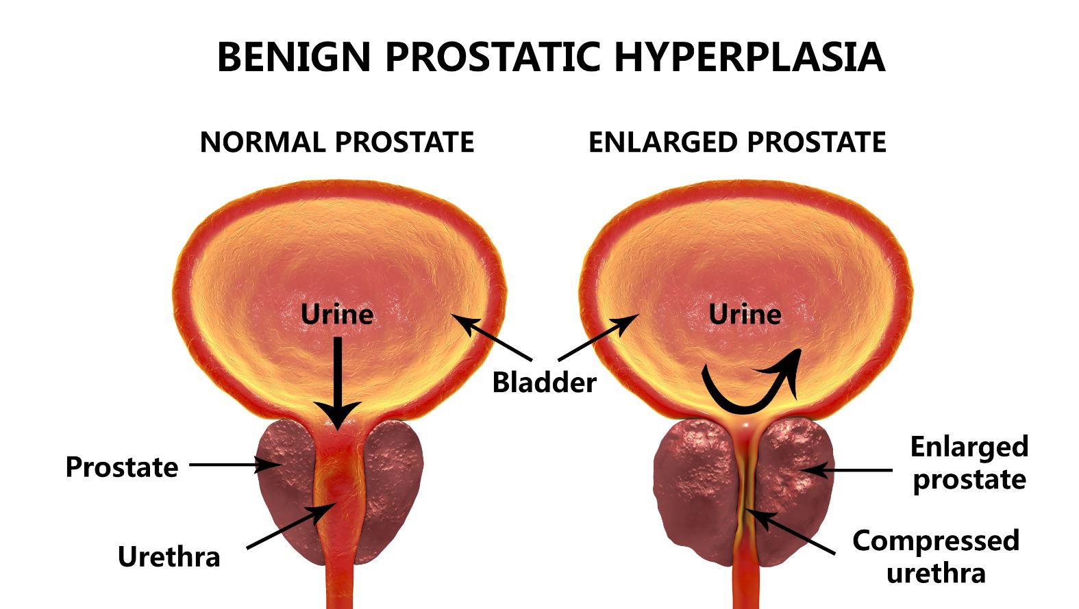 Enlarged Prostate Gland: Overview