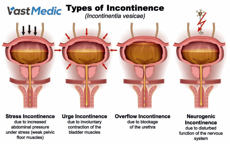 What Is Male Bladder Incontinence?